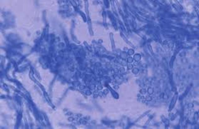 PITIRIASIS VERSICOLOR