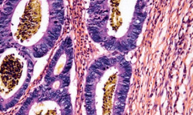 uso del fármaco pembrolizumab en el tratamiento de tumores sólidos avanzados.