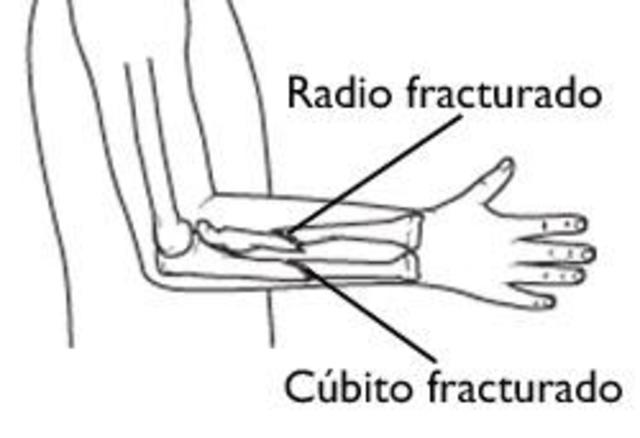 Me fracturé por primera vez un hueso