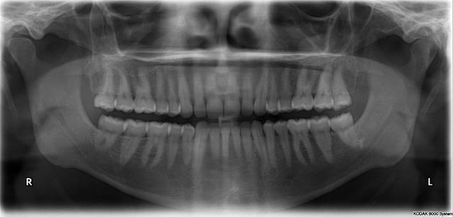 Teeth X-Rays
