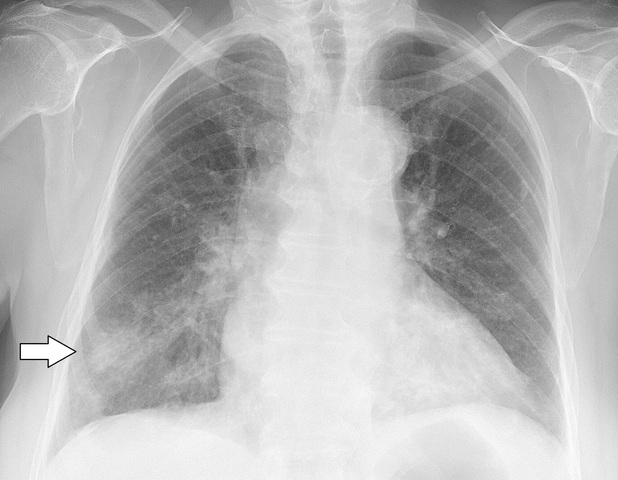 The Big Case of Pneumonia
