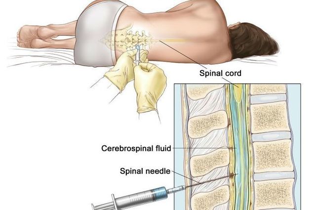 Epidural like in the 1900s