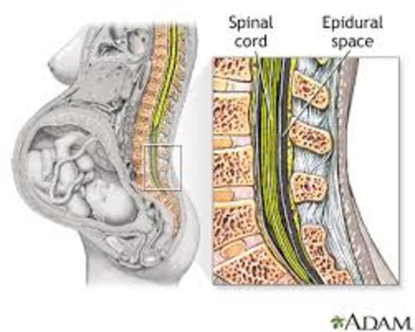 Epidurals For the 2000s