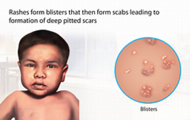 Disvoeries Of Small Pox