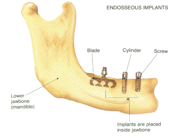 vitallium screw implant