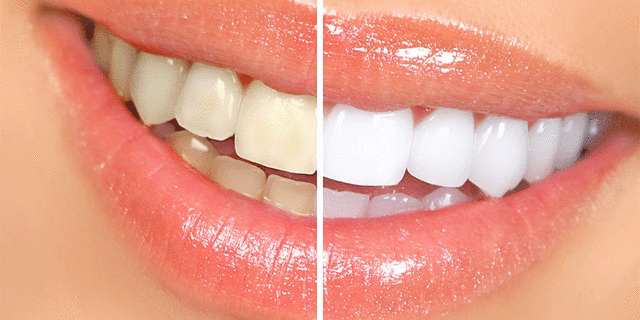 home tooth bleaching