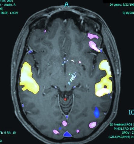 Ogawa y la resonancia Magnetica funcional