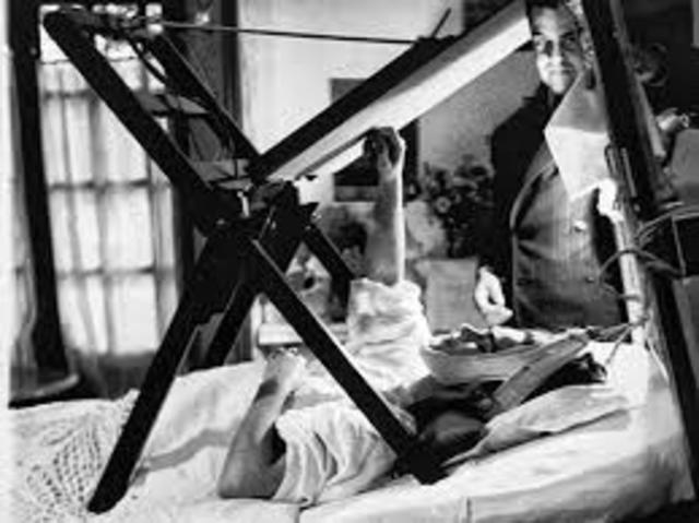 contracted poliomelitis