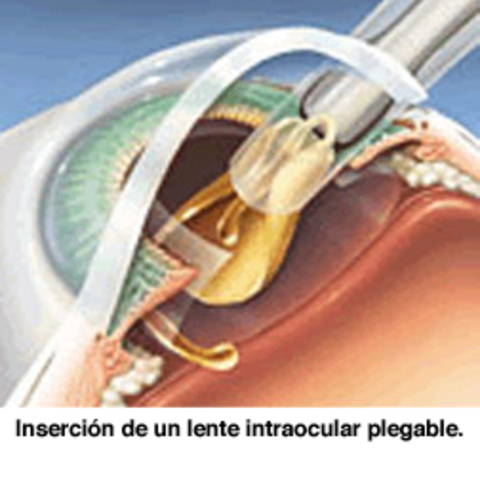 Lentes intraoculares