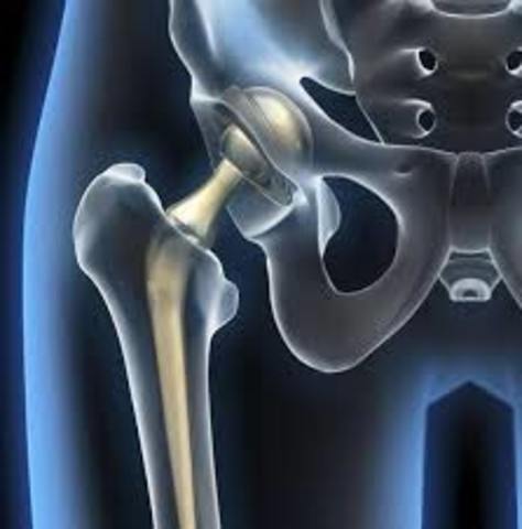 Protesis de cadera y de rodilla