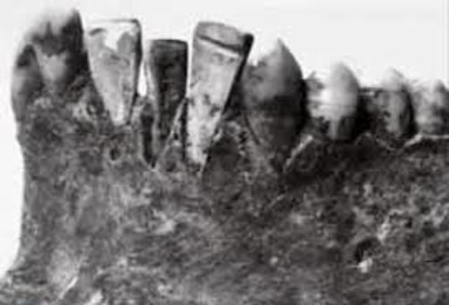 Periodo Neolítico Implantes Dentales