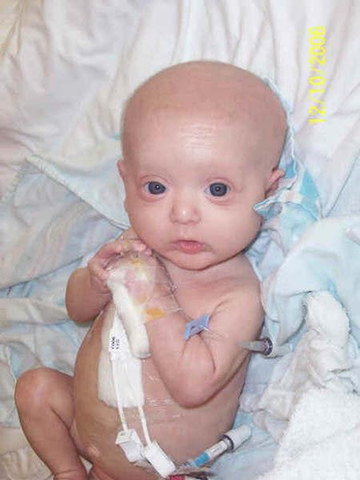 leucemia linfocitica