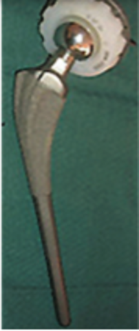 Edad Contemporanea Protesis de Articulacion de Cadera