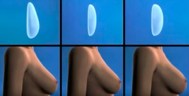 Edad Contemporánea: Implantes de pecho