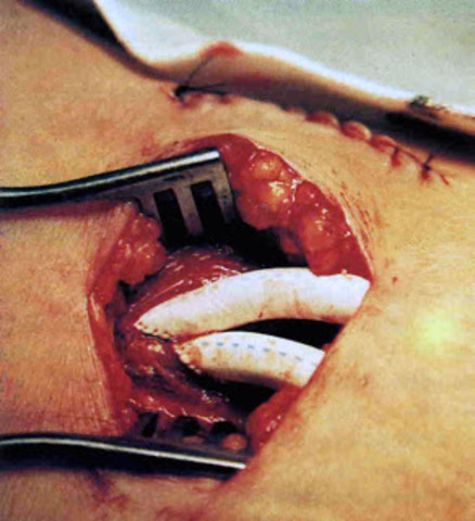 Edad Contemporanea: Los injertos Vasculares