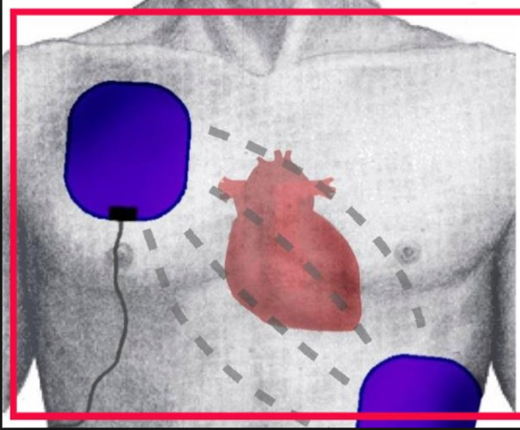 Edad Moderna: El marcapasos