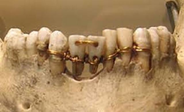 Antiguedad Implantes Dentales