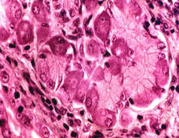 Citología y cáncer de Cervix