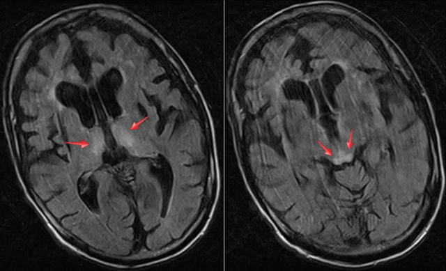 Agentes infecciosos en el SN