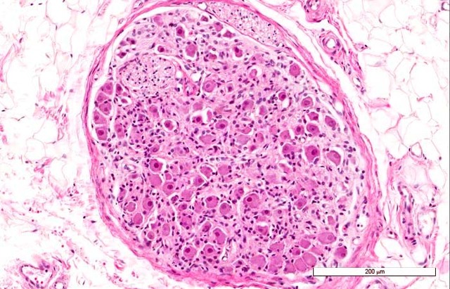Aparición de ganglios o núcleos