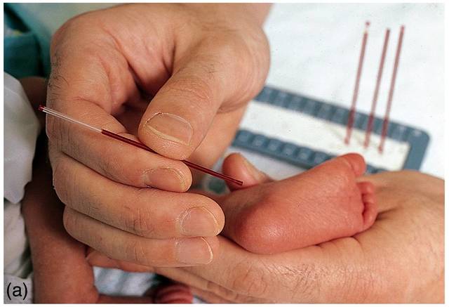 Prueba de Guthrie (Inhibición bacteriana por fenilalanina) como heraldo de la detección neonatal