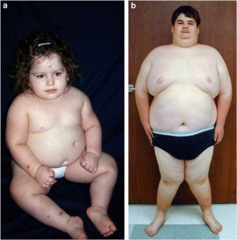 El síndrome de Prader-Willi es el primer síndrome por microdeleción reconocido