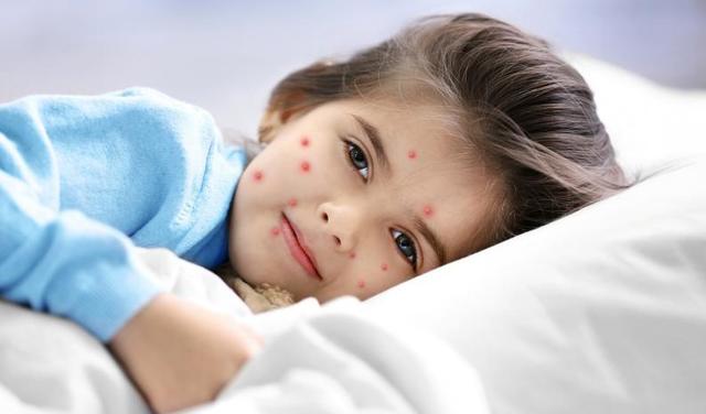 Se le diagnostica varicela, sarampión y rubeola