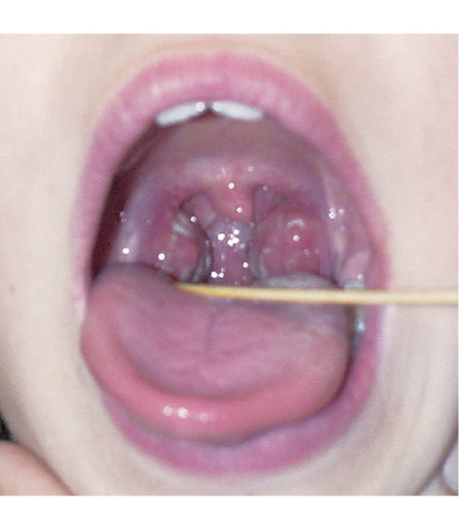 Se enferma de Faringoamigdalitis