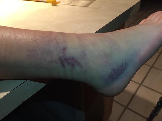 I sprained my ankle.