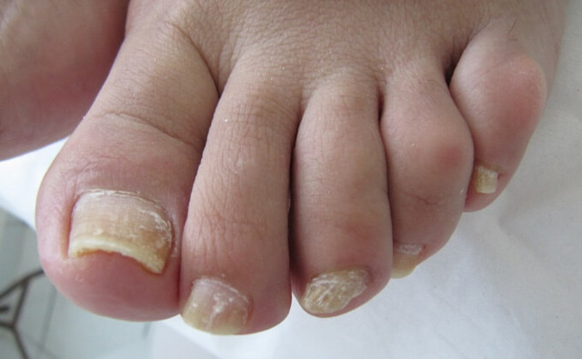 Se infecta de Onicomicosis