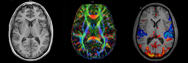 MRI (resonancia magnética) por Sir Peter Mansfield y Paul C. Lauterbur (1929-2007). "Usa una medida indirecta, que es el flujo de oxígeno en sangre derivado del consumo metabólico asociado a la realización de una actividad" (Moreno, 2018, p.4).