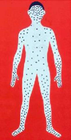 Erradicación de la Viruela