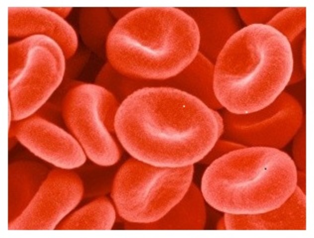 Es descrita por primera vez la anemia perniciosa.