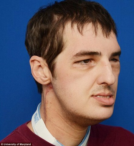 Primer trasplante total de cara.