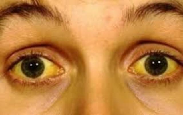 Fiebre amarilla 2016