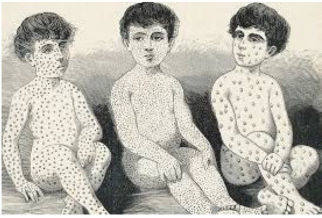 Sarampión (pandemia)*