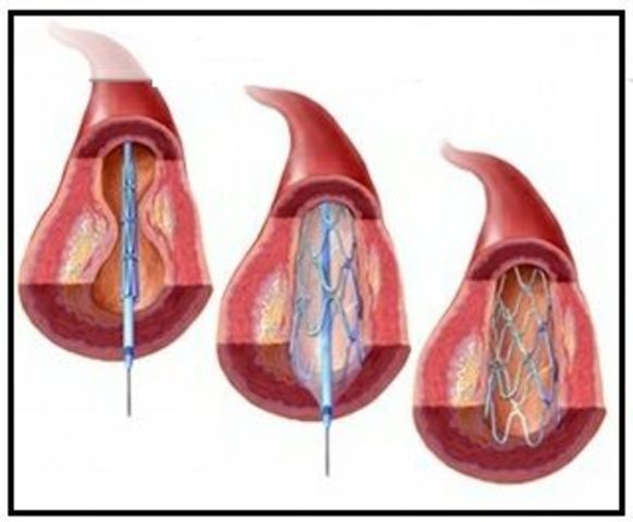 STENT EXPANSIVO