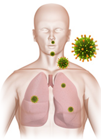 índrome respiratorio agudo severo (SRAS)