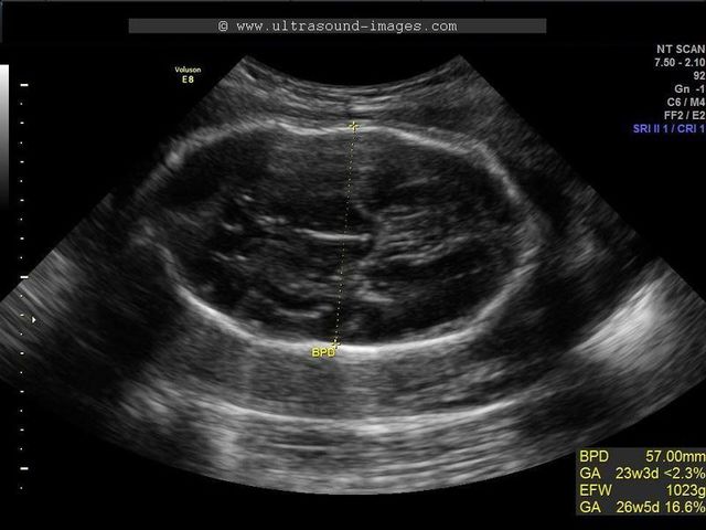 Fetal Ultrasound