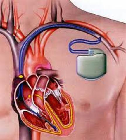 The invention of the Pacemaker