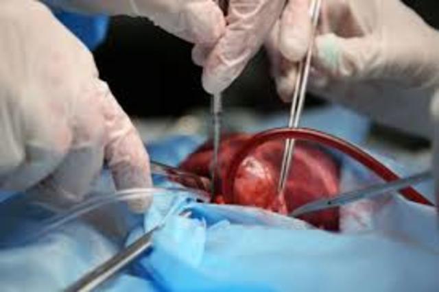 Organ Transplants
