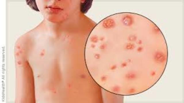 Chicken Pox
