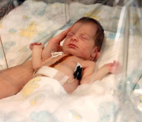 Baby Fae survives 21 days after being transplanted with the heart of a baboon.