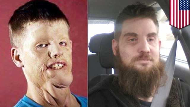 World's First Full-face Transplant