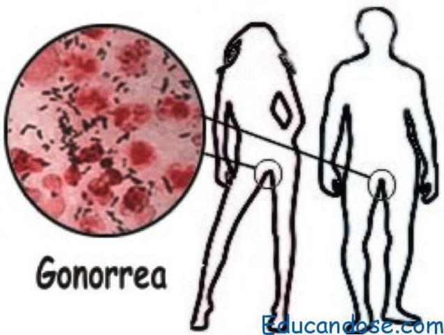 Gonorrea