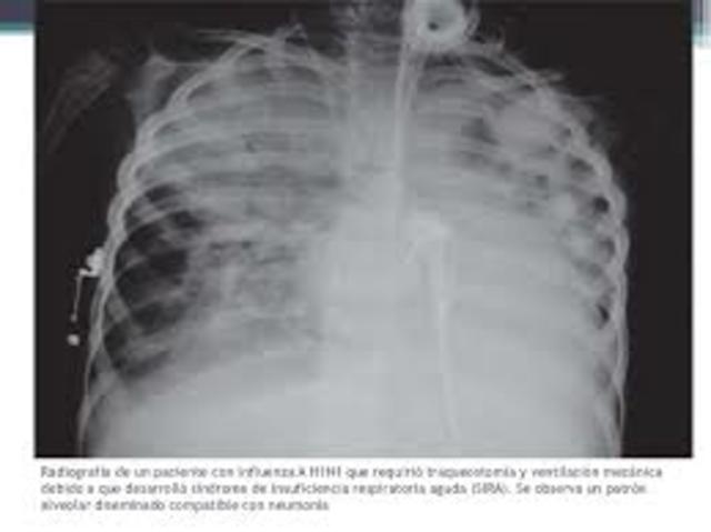 Síntomas y complicaciones de la gripe por H1N1