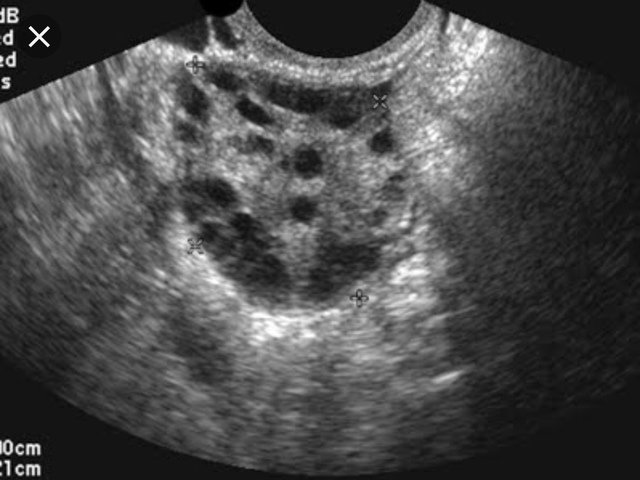 Descubrimiento de la sonografia