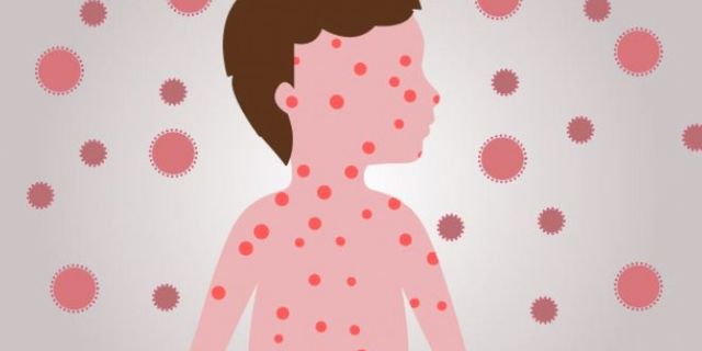 Lanzamiento de la Iniciativa de Lucha contra el Sarampión