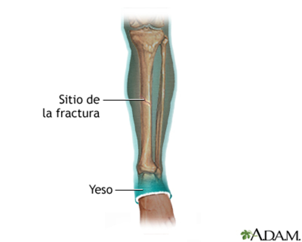 Fijación de Fracturas