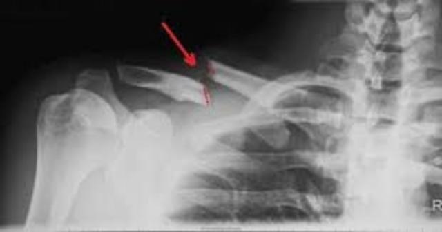 When I broke my collarbone